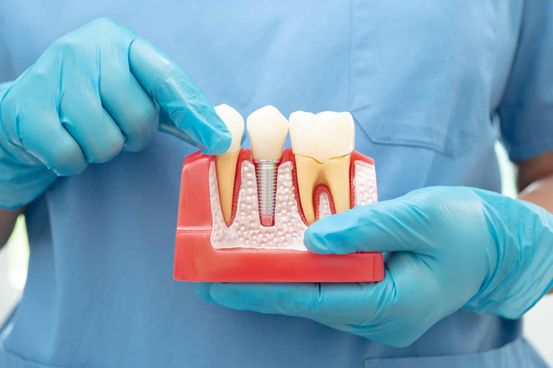 A person wearing blue gloves holds a dental model, showcasing a dental implant nestled between two natural teeth.