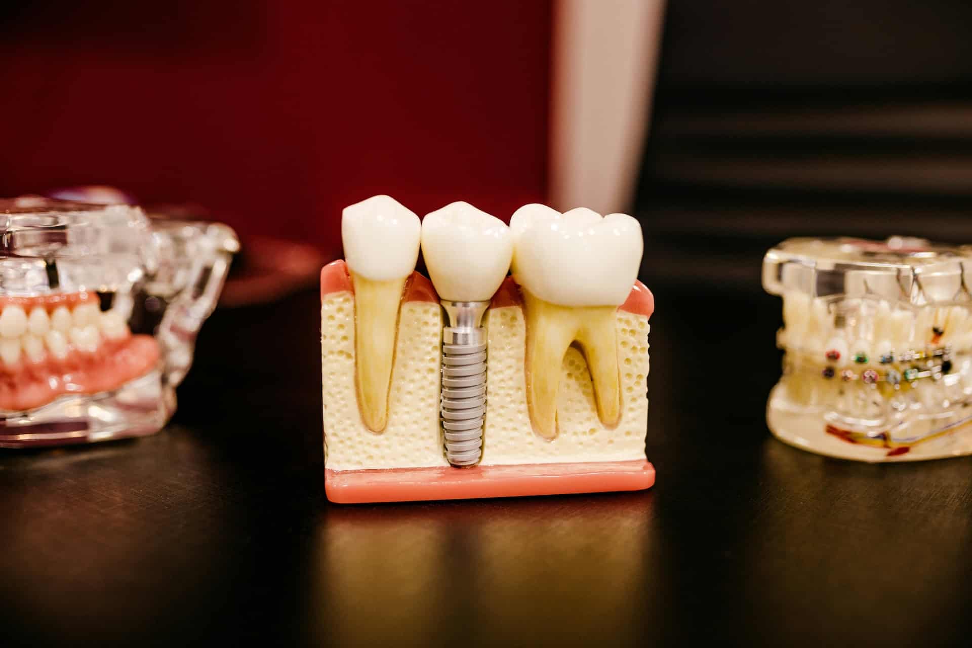 A dental model showcases a dental implant flanked by two natural teeth, illustrating the contrast with a root canal procedure